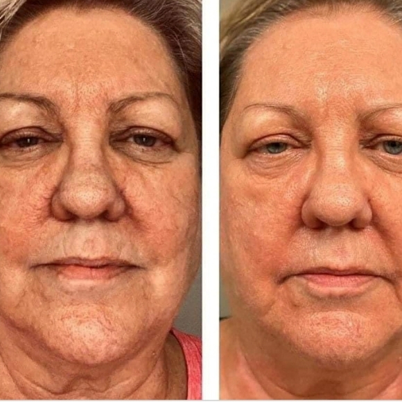 Clinical retinol - Picture 2 of 4